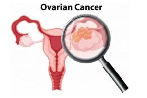 Waspadai Penyebab Kista Ovarium pada Remaja