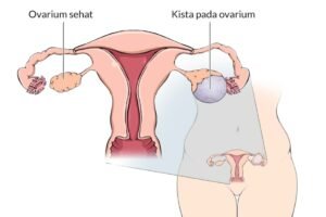 Waspadai Penyebab Kista Ovarium pada Remaja
